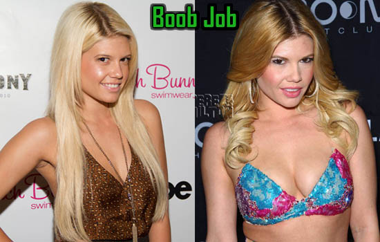 Chanel West Coast Boob Job Plastic Surgery Before After