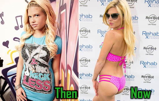 Chanel West Coast Boob Job Plastic Surgery Before After