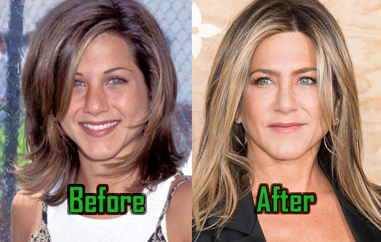 Jennifer Aniston: Plastic Surgery Alters Her Nose! Before-After Photos! | CelebritySurgeryIcon