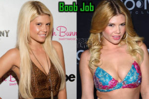 Chanel West Coast Boob Job, Plastic Surgery Before After