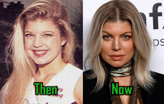 Fergie Before After Surgery
