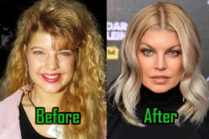 Fergie Plastic Surgery: Did She Really Have It?