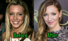 Katie Cassidy Surgery Photo, Before After