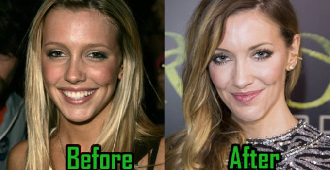 Katie Cassidy Surgery Photo, Before After