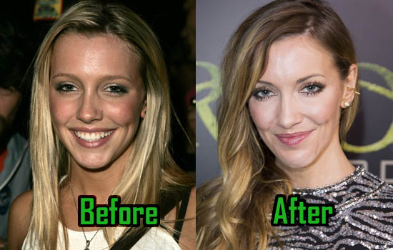 Katie Cassidy Surgery Photo, Before After