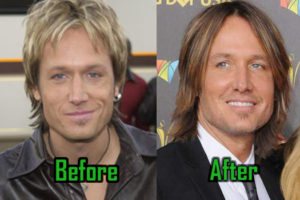 Keith Urban Plastic Surgery Left Him Barely Recognizable