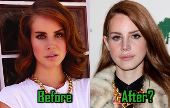 Lana Del Rey Plastic Surgery, Before After