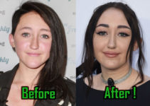 Noah Cyrus Excessive Plastic Surgery: Before and After
