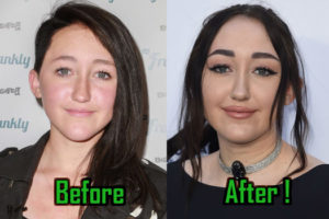 Noah Cyrus Excessive Plastic Surgery: Before and After