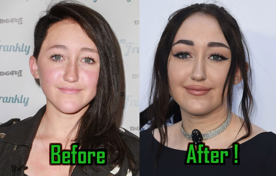 Noah cyrus plastic surgery before and after photos