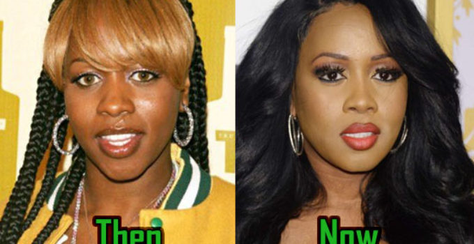 Remy Ma Cosmetic Surgery