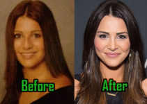 Andi Dorfman Plastic Surgery, Nose Job, Fillers, Before & After