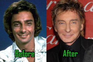 Barry Manilow Surgery