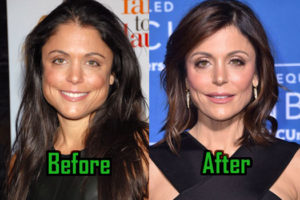 Bethenny Frankel Plastic Surgery: Jaw Reduction & Facelift? Before-After!