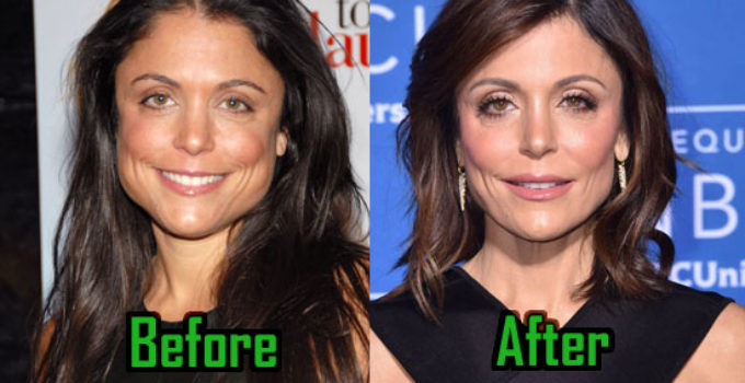 Bethenny Frankel Plastic Surgery