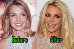 Britney Spears: Plastic Surgery Behind Her Unusual Look, Before-After!