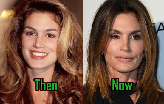 Cindy Crawford Surgery, Facelift