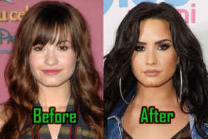 Demi Lovato Plastic Surgery: Nose Job, Chin Surgery, Before After!
