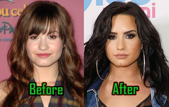 Demi Lovato Plastic Surgery