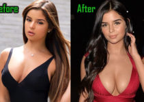 Demi Mawby Plastic Surgery, Boob Job, Before After!