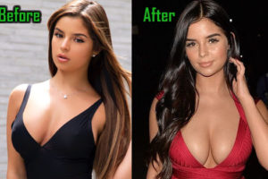 Demi Mawby Plastic Surgery, Boob Job, Before After!