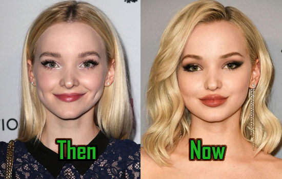 Dove Cameron Surgery, Lips Injection