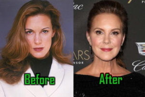 Elizabeth Perkins Plastic Surgery, Facelift, Fillers, Before After