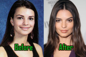 Emily Ratajkowski Plastic Surgery: Boob Job, Nose Job, Before After!