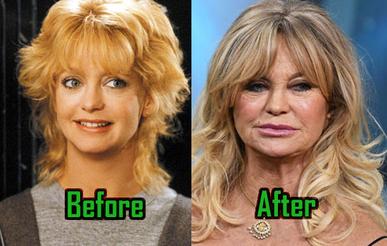 Goldie Hawn Facelift, Lips Injection