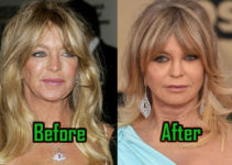 Goldie Hawn Plastic Surgery: Facelift, Injections, Before After!