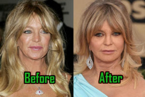 Goldie Hawn Plastic Surgery