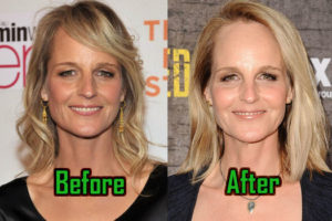 Helen Hunt Plastic Surgery: Facelift, Fillers, Before And After Photos!