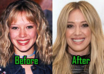 Hilary Duff Plastic Surgery: Nose Job & Boob Job? Before and After!