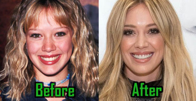Hilary Duff Plastic Surgery