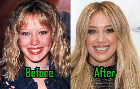 Hilary Duff Plastic Surgery