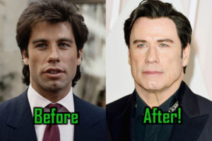 John Travolta Plastic Surgery: Terrible Facelift, Before and After Photos!