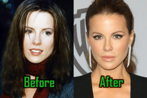 Kate Beckinsale Plastic Surgery: Nose Job, Botox, Before & after!