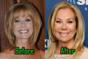 Kathie Lee Gifford Plastic Surgery: Facelift, Neck lift, Before After!