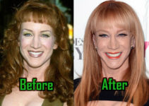 Kathy Griffin Plastic Surgery: Facelift, Liposuction, Before-After!
