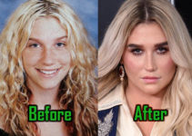 Kesha Plastic Surgery of Nose Job & Lips Filler, Before-After