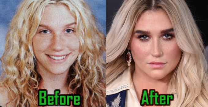 Kesha Plastic Surgery