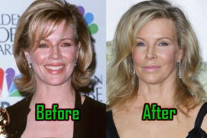 Kim Basinger Plastic Surgery, Before After