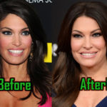 Kimberly Guilfoyle Plastic Surgery Photo