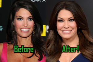 Kimberly Guilfoyle Plastic Surgery: Facelift Modified Her Face? Before-After!