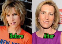 Laura Ingraham: Plastic Surgery for Facelift? Before-After Photos
