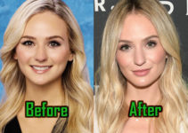 Lauren Bushnell Plastic Surgery: Nose Job, Lips Injection, Before-After!