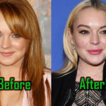 Lindsay Lohan Plastic Surgery