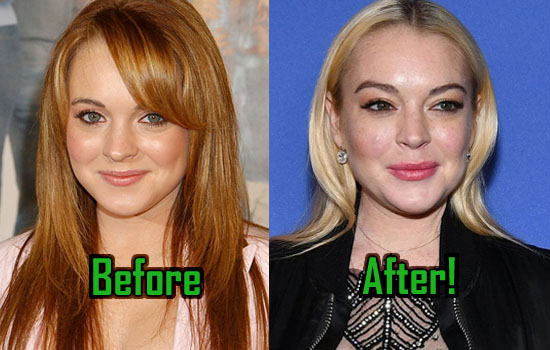 Lindsay Lohan Plastic Surgery Before And After