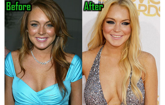 Lindsay Lohan Surgery, Boob Job