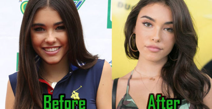 Madison Beer Plastic Surgery, Nose